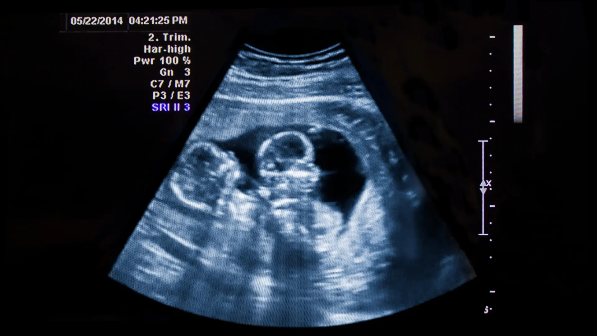 Usługa USG prenatalne ciąży bliźniaczej - dopłata za badanie drugiego płodu w CM Femmemedica